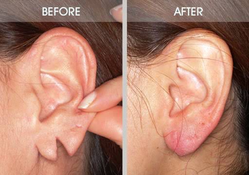 Earlobe Pasting